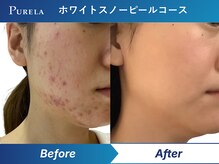 ピュアラ グランピュアラ難波店/大人気ホワイトスノーピール