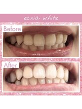 エクシアホワイトニング 天王寺店/ホワイトニングビフォーアフター