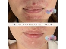 イロドリ(IRODORI)の雰囲気（3か月の継続ケアで、キメが整い透明感のある肌印象へ。）