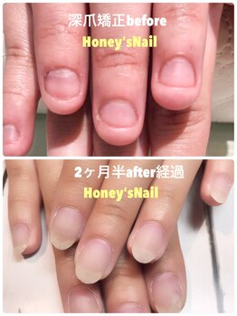 ハニーズネイル(Honey's Nail)/美爪育成施術前 →2ヶ月半経過