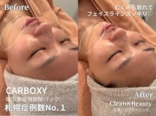 クリーンアンドビューティ 札幌(Clean&Beauty)/韓国カーボキシー札幌症例数No.1