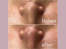 ティーツリー 名古屋 桜山(Tea Tree)/【毛穴ケア・毛穴洗浄】