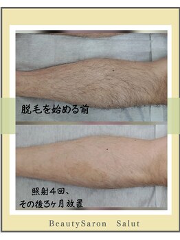 サリュ 行徳店(Salut)/足のムダ毛にお悩みの方に!