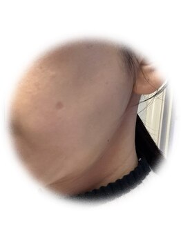 エラ(Ella)/プラズマチャレンジ &nbsp;1ヶ月経過