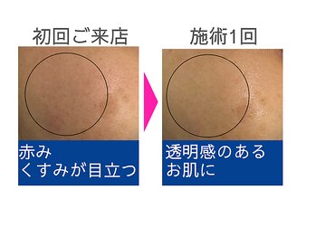 【本気の肌質改善】西新宿フェイシャルエステBelle≪ベル≫乾燥|赤み|毛穴|くすみの写真/【乾燥・赤み・毛穴悩みへ】丁寧なカウンセリングで原因を特定し、健康で美しい素肌へ導きます♪