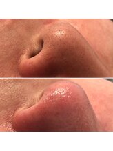 ベル リュンヌ(Belle lune)/毛穴エクストラクション