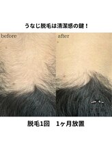 イエス 久留米店(YES)/うなじ脱毛ビフォーアフター