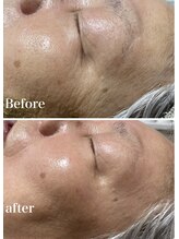 オーパーツ(OOPARTS)/シワ改善/毛穴/小顔