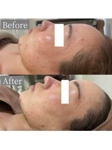 ホワイトアクア 鳳店(WHITE AQUA)/ハーブピーリング/毛穴/大阪/鳳