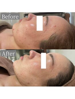 ホワイトアクア 鳳店(WHITE AQUA)/ハーブピーリング/毛穴/大阪/鳳