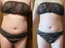 サラン鍼灸院(SARAN都楽鍼灸院)/よもぎむし×エンダモロジー結果