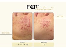 ハーバル 新宿店(HERBAL)/最強★韓国FCRハーブピーリング