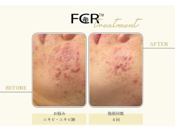 ハーバル 新宿店(HERBAL)/最強★韓国FCRハーブピーリング