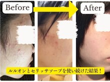 ヨサパーク リバティ 三田(YOSA PARK Liberty)/肌荒れ知らずの美肌が叶う！