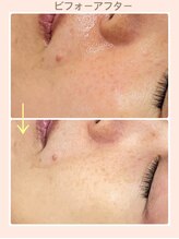 リファイン(REFINE)/毛穴のたるみもキュっと引き締め