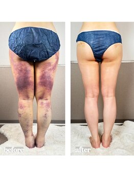 術後の女神 大阪本町店/ダウンタイムケア・インディバ