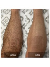 アート 熊本並木坂店(ART)/ワックス脱毛/ひざ下