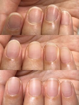 ハッチネイル(HACCI nail)/お客様Beforeafter　3か月