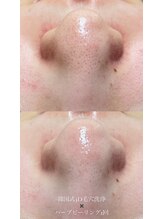 クレヴィー(Creviy)/韓国式3D毛穴洗浄×ハーブ1回後