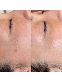 ジン フォー ユアビューティー(JIN for your beauty)/施術経過