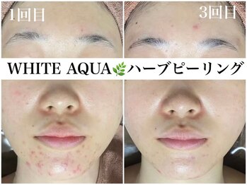 ホワイトアクア 福岡天神店(WHITE AQUA)/ハーブピーリング1回~3回