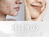 【何をしても改善されないニキビに終止符】剥けないハーブピーリング(60分)