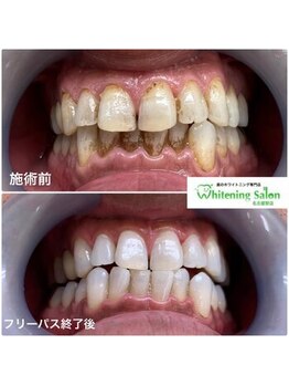 ホワイトニングサロン 名古屋駅店/【ホワイトニング施術例】