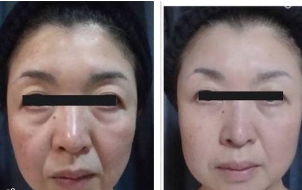 北九州市小倉北区で毛穴洗浄・毛穴吸引が人気のエステサロン