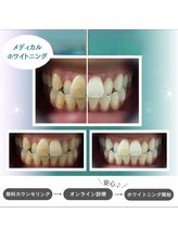 ルミナ(LUMINA)/プレミアムホワイトニング