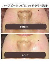 シフォン(Chiffon)/毛穴洗浄で小鼻の黒ずみ対策