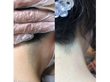 ビーダブリュー(BW...)/いたくない！SHR光脱毛　施術3回