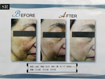 ビビ(BIBI)/光フェイシャル