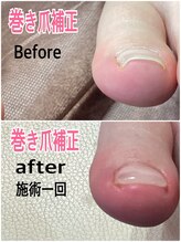 モアクリスタル(More Crystal)/巻き爪補正