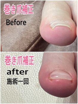 巻き爪補正