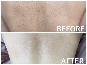 ハーブピーリング 恵比寿/くすみ改善