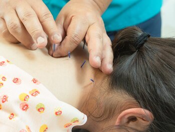 葛西施術院/肩回りに刺鍼