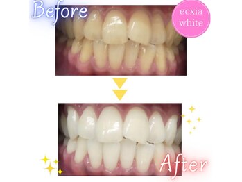 エクシアホワイトニング 新白河店/ホワイトニングビフォーアフター