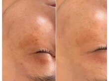 ジン フォー ユアビューティー(JIN for your beauty)/施術経過