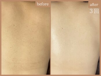 リムーン 岡崎(Re'moon)/REVI ハーブピーリング お背中