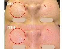 ソルニコン(Solnikon)/陶肌トリートメント