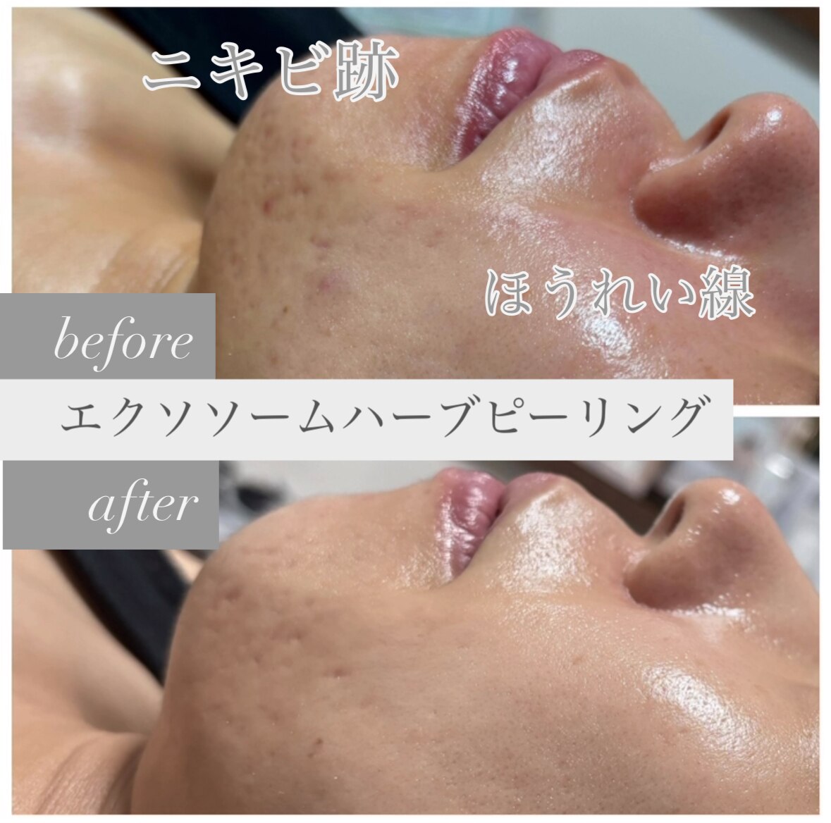 sky様専用 剥離ありハーブピーリング20回分 スカイ(sky sky様専用 剥離ありハーブピーリング20回分 スカイ(sky