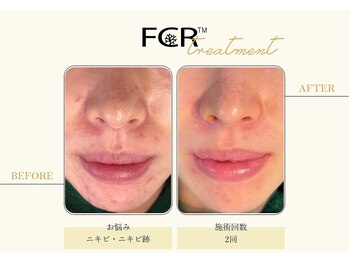 ハーバル 新宿店(HERBAL)/最強★韓国FCRハーブピーリング