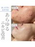 【原因究明】繰り返すニキビをカウンセリング+ニキビケア/一生モノの素肌を