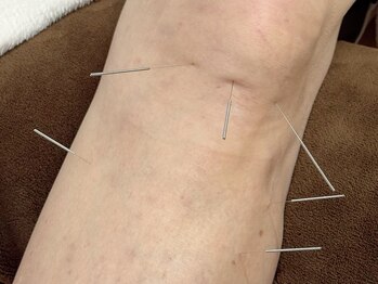 命水鍼灸院/膝痛【新宿/鍼灸】