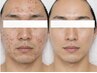 【繰り返す男性ニキビ】第一印象で差をつける/肌診断で原因を特定/清潔な肌へ
