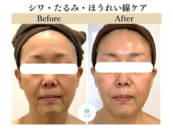 ミューズ 成城(MUSE)の写真/【たるみ・フェイシャル・しわ・小顔・ハーブピーリング】目元・口元・お首のたるみ・小じわを改善