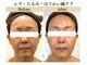 ミューズ 成城(MUSE)の写真/【たるみ・フェイシャル・しわ・小顔・ハーブピーリング】目元・口元・お首のたるみ・小じわを改善