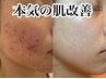 【ニキビでお悩みの方】結果重視のハーブピーリング！変化を感じたいならこれ