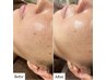 【たるみシミ改善】最新"陶器肌タイトニング・リフティング/トーニングフォト