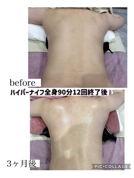レイ(Ray)/ハイパーナイフ全身90分×12回